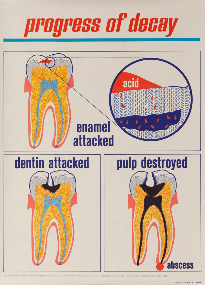 Progress of Decay, Original ADA American Dental Association Poster