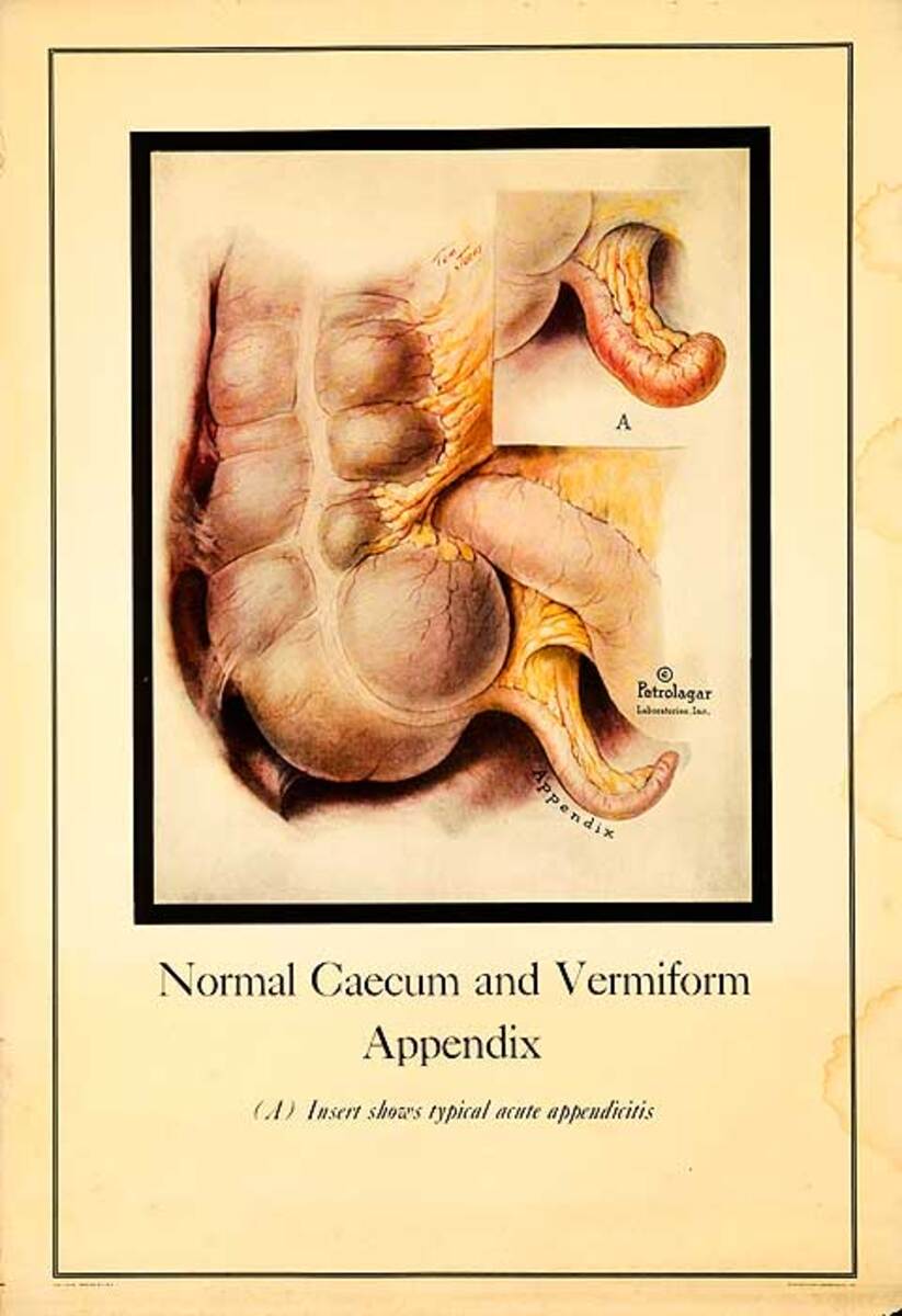 Petrolagar Laboratories Medical Chart Normal Caecum and Veriform Appendix