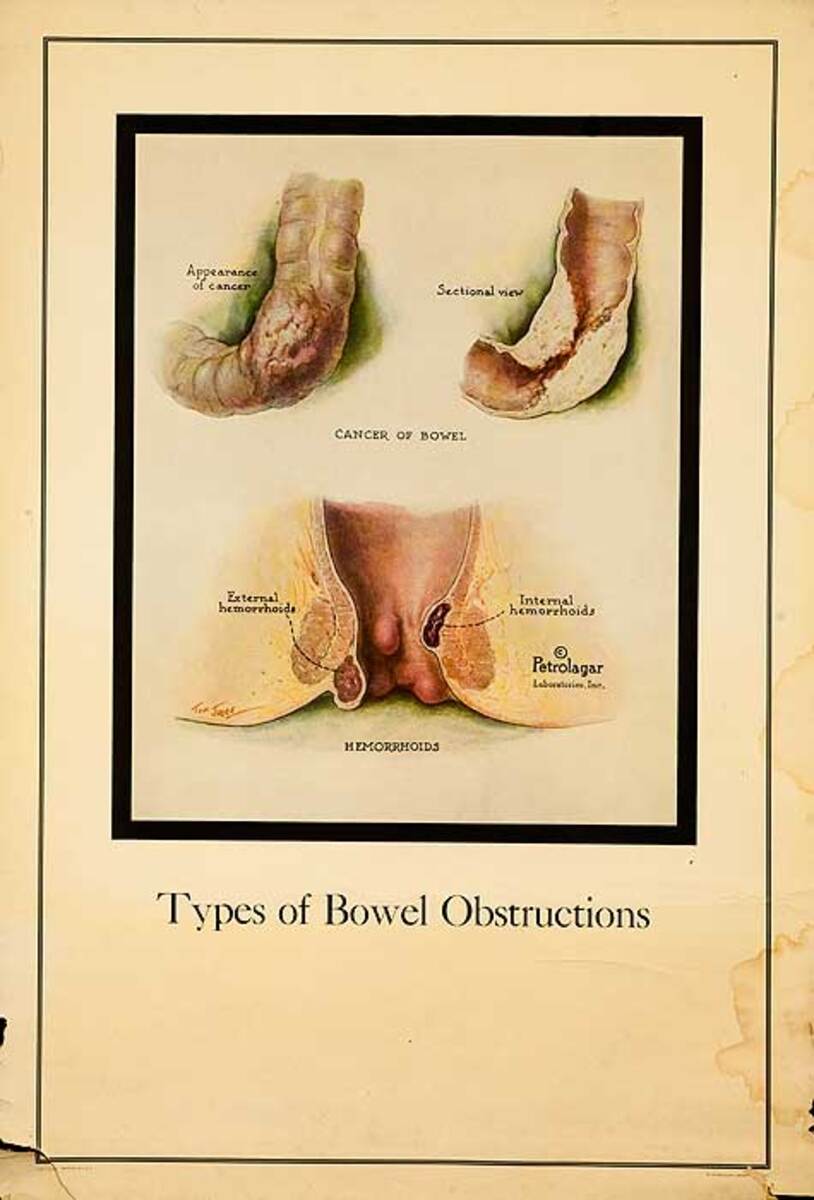 Petrolagar Laboratories Medical Chart Types of Bowel Obstructions